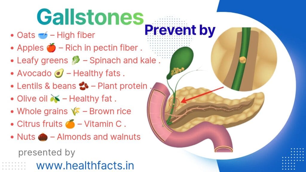 Foods to Prevent Gallstones Naturally