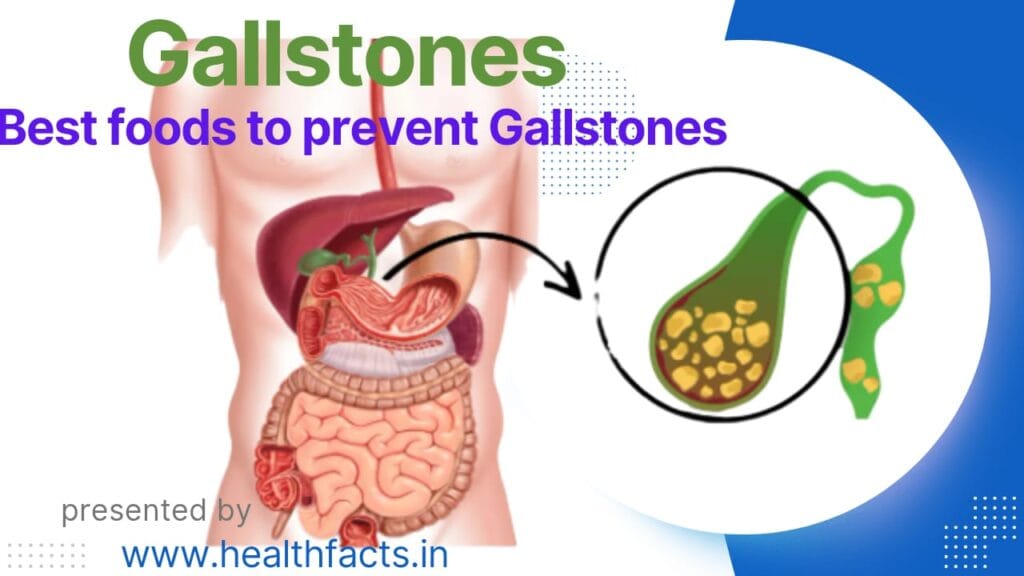 Foods to Prevent Gallstones Naturally